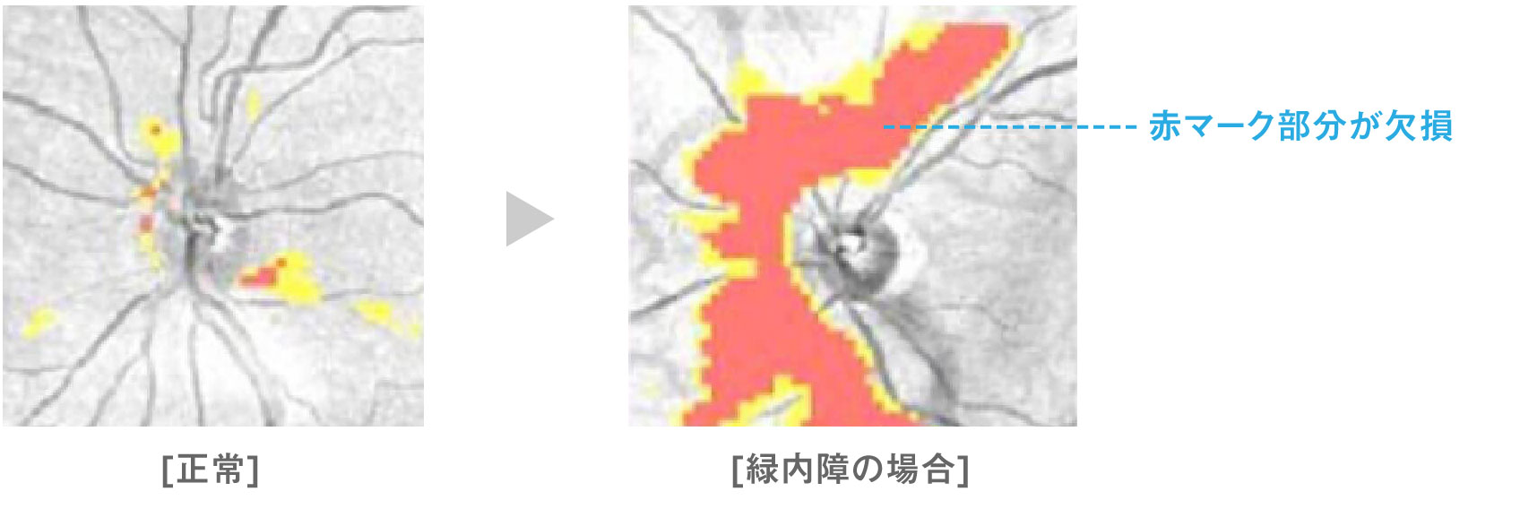 OCT装置で検出された、視神経繊維層の欠損（赤い部分）